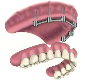upper_implant_denture3